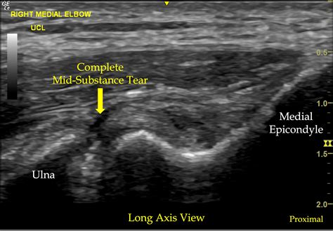 annular ligament tear test|elbow annular ligament tear symptoms.